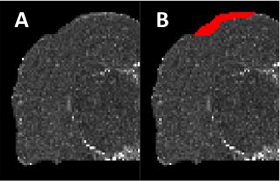 T2 weighted MR image of half a coronal slice from the rat model dataset. A) Original T2 weighted image. B) Manual detection of the mTBI lesion (highlighted in red).